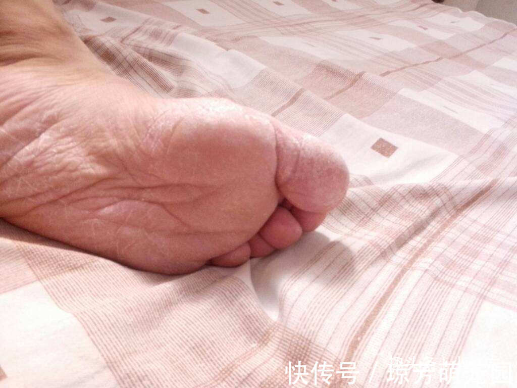 黄疸|小小一粒“豆”,内服治脚气水肿,外敷搞定痤疮,等十几种皮肤病