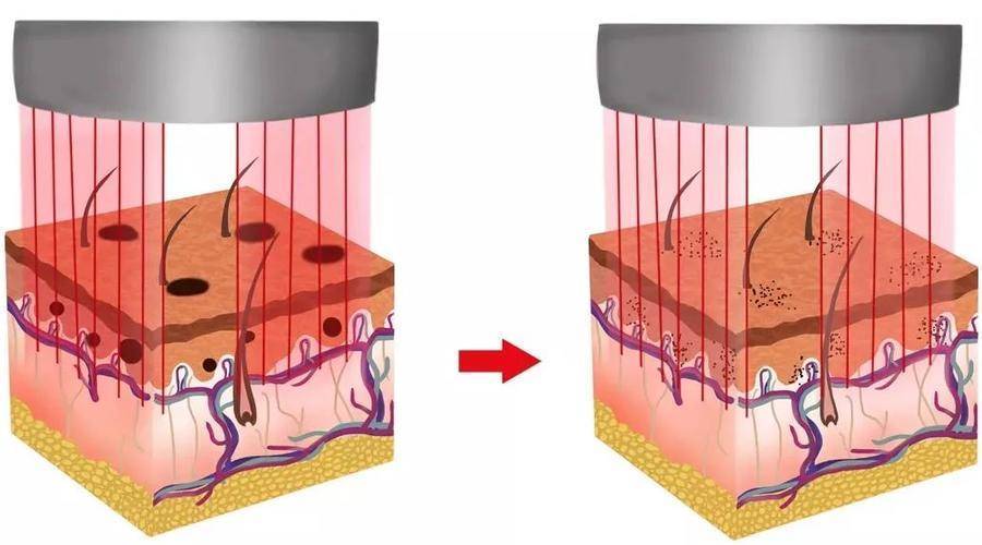 反黑 做完光子嫩肤之后反黑了怎么办呐?什么是反黑?术后该如何护理?
