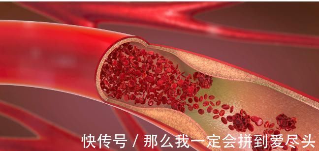 凝血功能|癌症为什么会导致血栓?多与2个原因有关,做好3点可预防