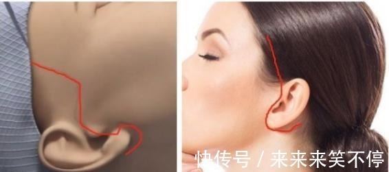 无痕 “大拉皮手术”后又美又无痕,医生是要费些心思的!