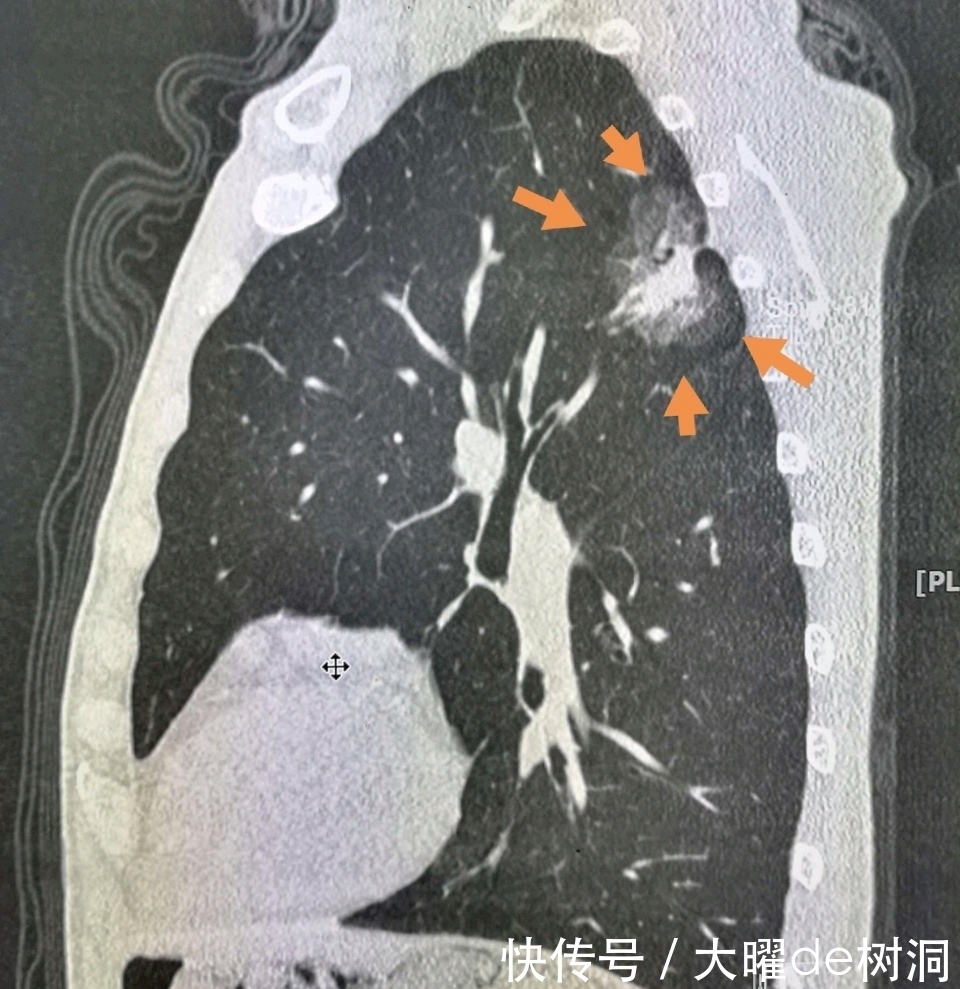 年年体检,为什么还得了晚期肺癌?体检有啥用!
