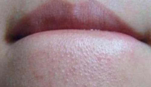 为何下巴长了很多小疙瘩？教你2个实用方法，快速去除小疙瘩