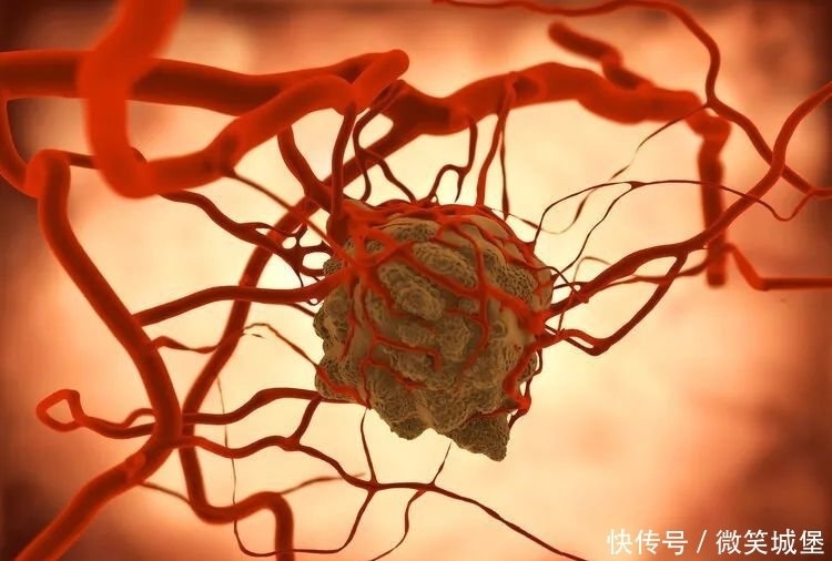 里程碑突破!国产抗癌药闪耀世界大会舞台,可“饿死”多种癌症