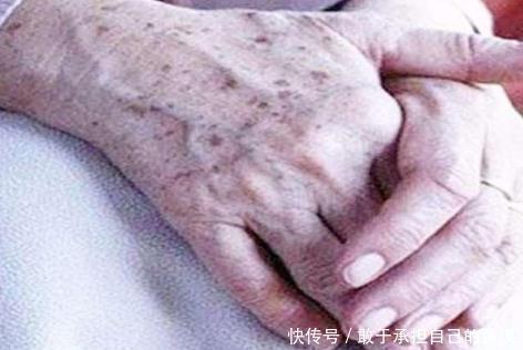 最新版|为何有的人老年斑一大片，有的人却没有呢告诉你背后真正的原因