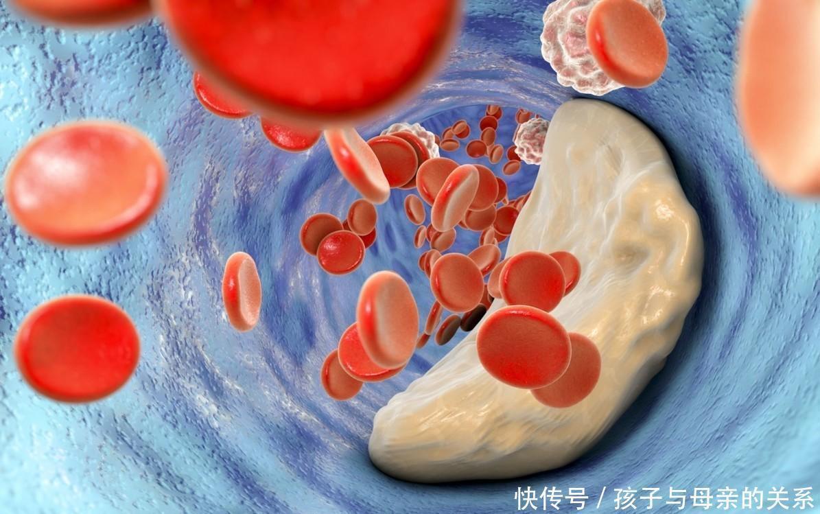 血液|43岁男子,高血脂到脑梗仅不到半年,医生叹息:1种调料是祸根