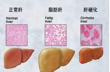  素食者|有脂肪肝的人可以多吃鸡蛋吗？为何素食者也会得脂肪肝？如何调理