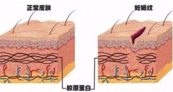 妊娠纹|只要妊娠不要纹，你知道该如何远离妊娠纹吗？