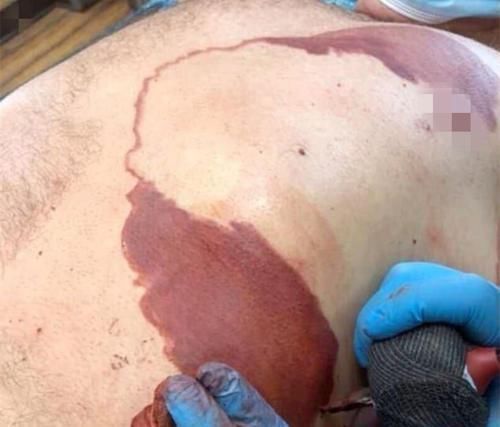 手术切除|小男孩因胎记感到自卑,爸爸一个做法获高赞,网友:最美“胎记”