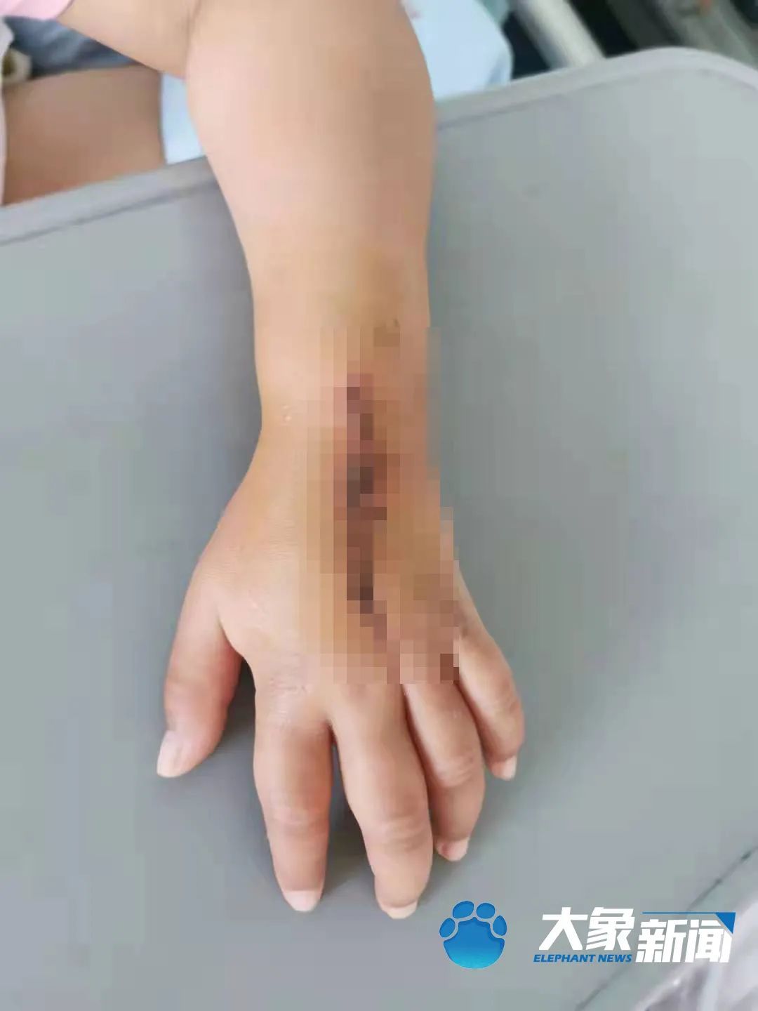 恶性肿瘤|甘肃10岁女童患国内罕见恶性肿瘤,全国仅2台治癌利器却无法使用