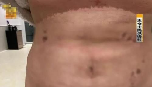女子花近3万做抽脂手术，结果出现大面积淤青：老公都不敢碰我了