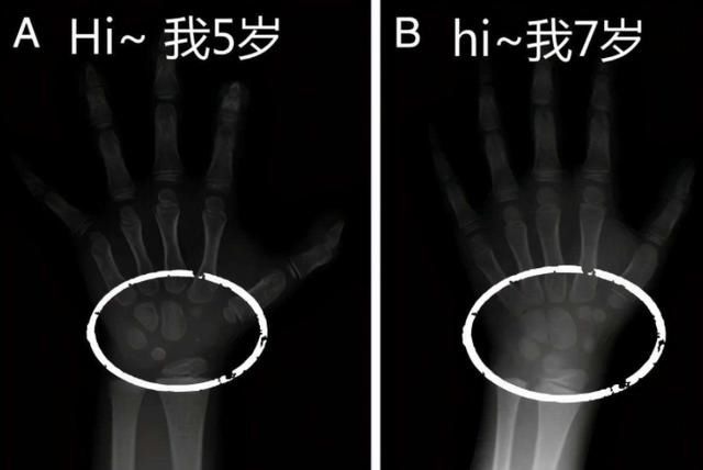 垃圾食品|宝宝“骨龄”偏大，未来一定会比别人矮吗？家长可帮娃发掘潜力