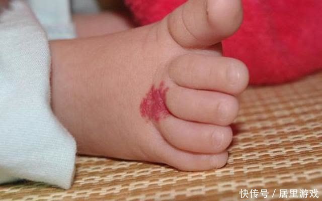 宝宝|宝宝为什么会长胎记?与孕期行为有关,孕妈怀孕后要克制自己