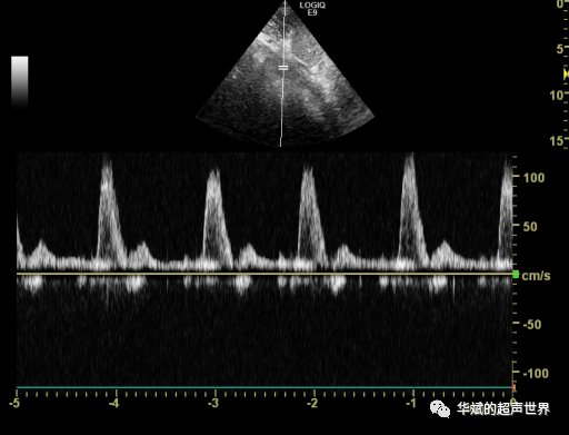 频谱|腹主动脉“小慢波”，你怎么啦？