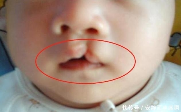 谎称|孕妈生下“兔唇”宝宝,谎称孕期食用兔肉,被医生戳穿后尴尬不已