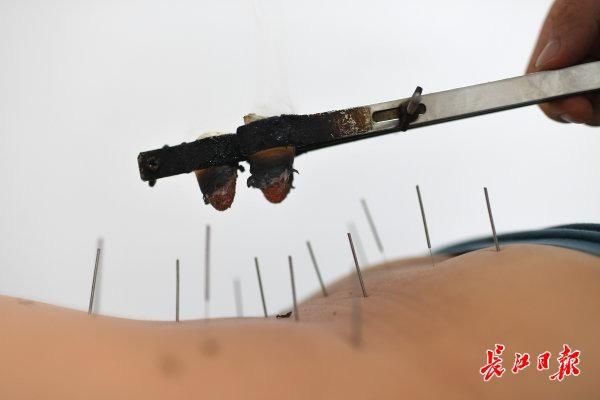 国医堂|火罐“拔出”中医热