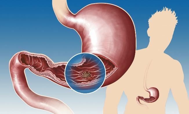 检查|消化系统疾病要做什么检查？6种检查方法，可灵活运用