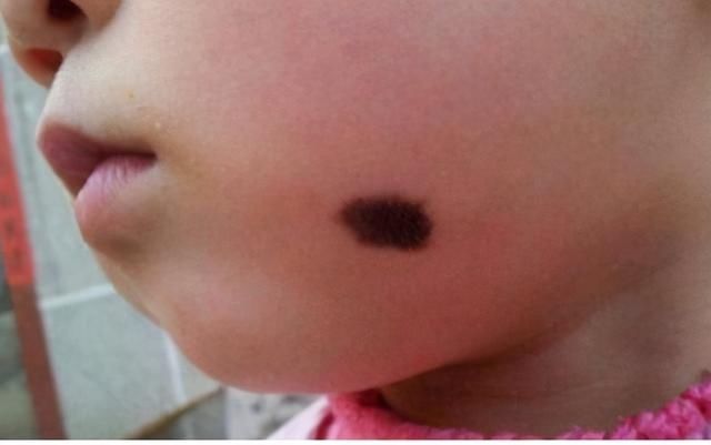 垃圾食品|胎记是如何形成的？产科大夫：除了遗传，和孕妈3种不良行为有关