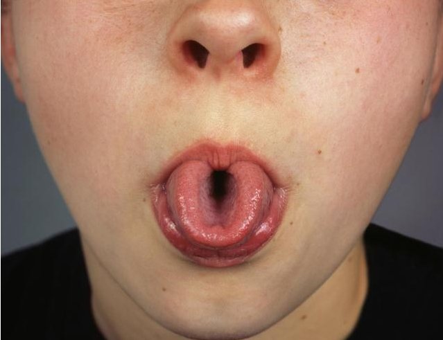 假膜|舌头的表现预示身体出现问题，舌头下有“青筋”，表明问题出在哪里？