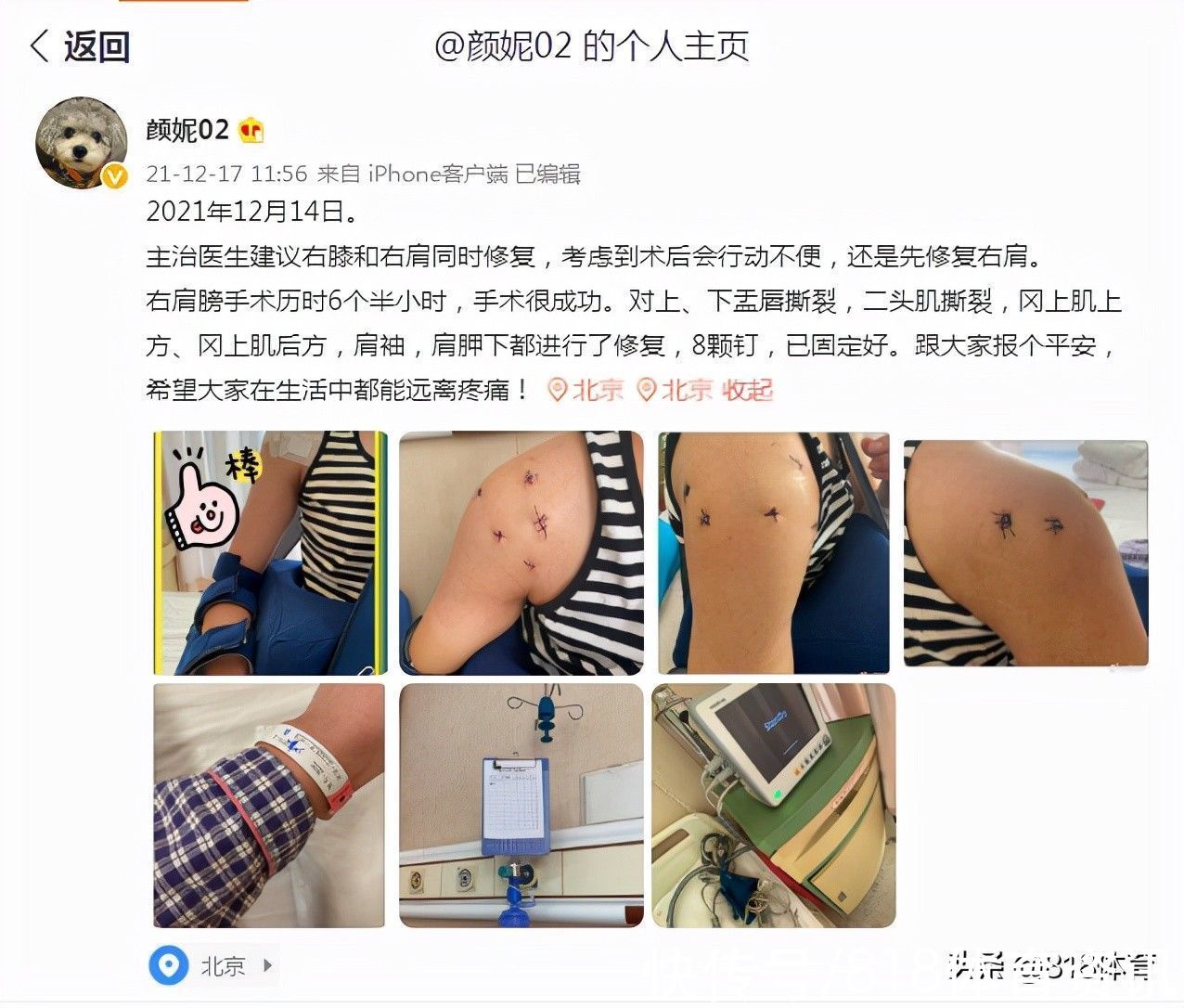 手术|泪目!女排北长城颜妮6个半小时手术报平安,修复右肩成功打8颗钢钉