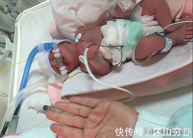 软便剂|终于卸货啦!让我不敢再回想的双胞胎待产和生产记录,住进ICU