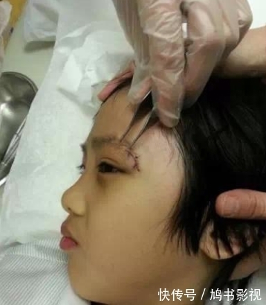 正臉|錄《爸爸去哪兒》造成眼角永久性傷害的費曼露,放下心結露正臉