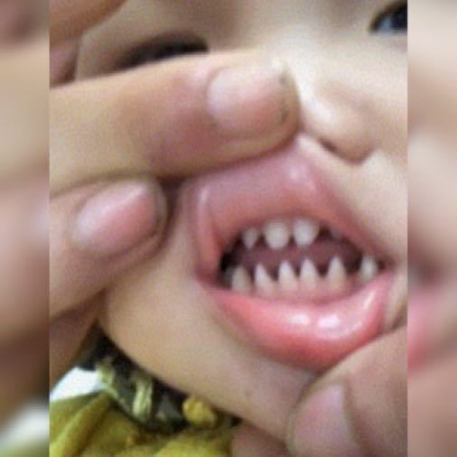 牙齿|萌娃张口的一瞬间令人诧异,牙齿像“鲨鱼牙”,网友父母惹的祸