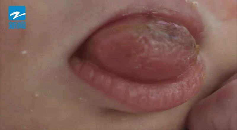 肿瘤|罕见！宝宝出生时口含“龙珠”，爸妈却急坏了
