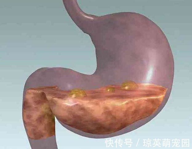 蒲公英|胃癌多是自己“养”起来的,专家忠言:5种食物,还是少碰为好