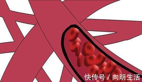 脑梗|血管堵塞,百病生每天五分钟按一按“化栓穴”,通血管,防脑梗