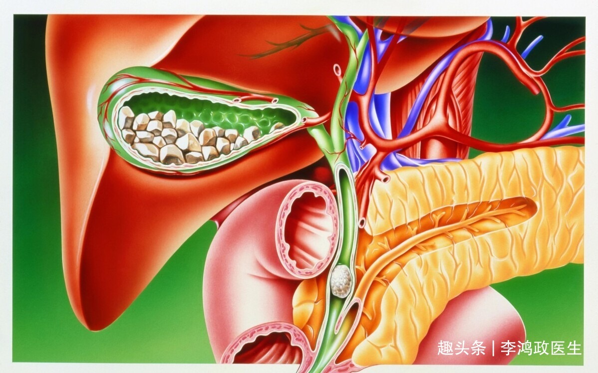 胰腺癌|女子口渴、尿多，以为是糖尿病，直到上腹部不适医生才发现是癌症