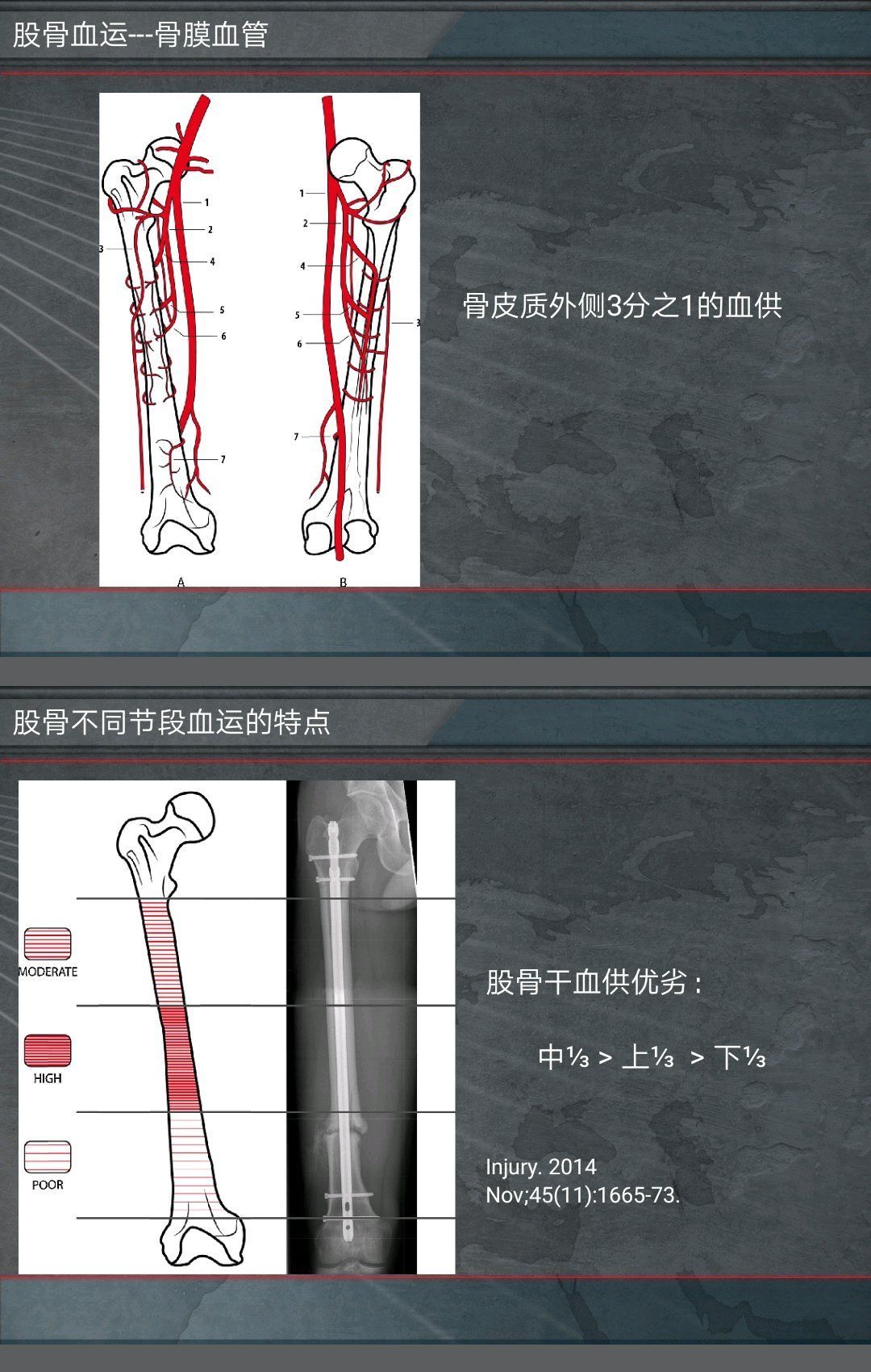 骨髓腔|交锁髓内针治疗股骨干骨折