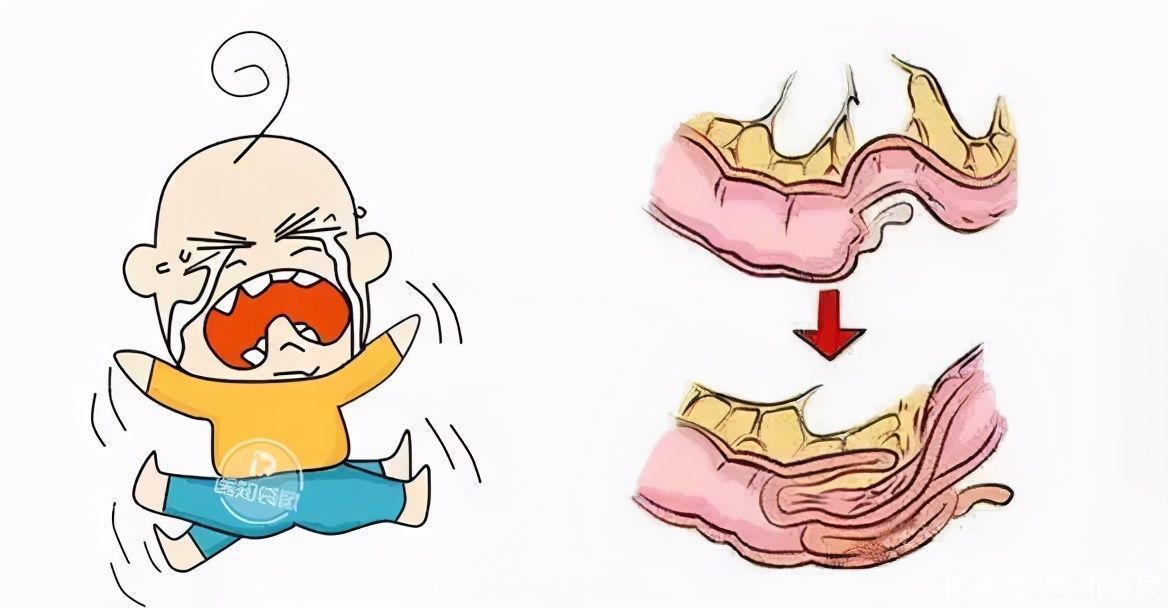 阑尾炎|宝宝肚子疼揉揉就好了？这2种情况赶紧去医院