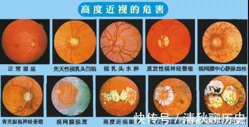 眼球|近视的眼球如同一个吹大的气球，近视度数越高，气球越大，越危险