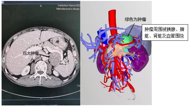 烟台附院|滨医烟台附院完成高难度腹腔镜下肾上腺嗜铬细胞瘤切除术