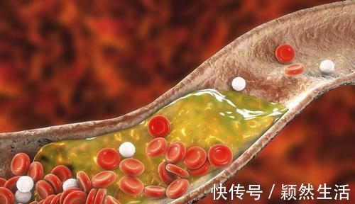 体检|体检查出颈动脉斑块必须吃药?医生:比起吃药,还有件事同样重要