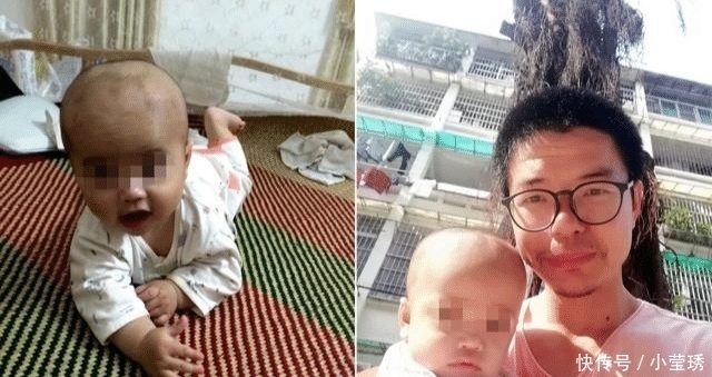 男婴脸上长了一个红疙瘩，后被切除半张脸，10天后又确诊癌症