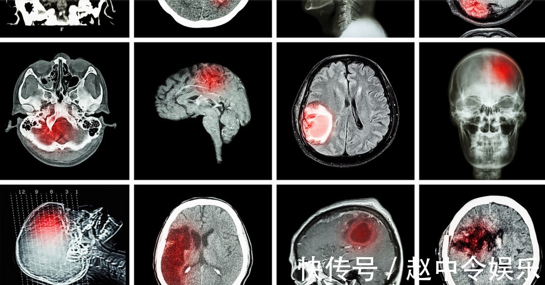 排出体外|吃一次等于喝“一桶油”，54岁男子查出脑梗塞，因经常吃2种早餐