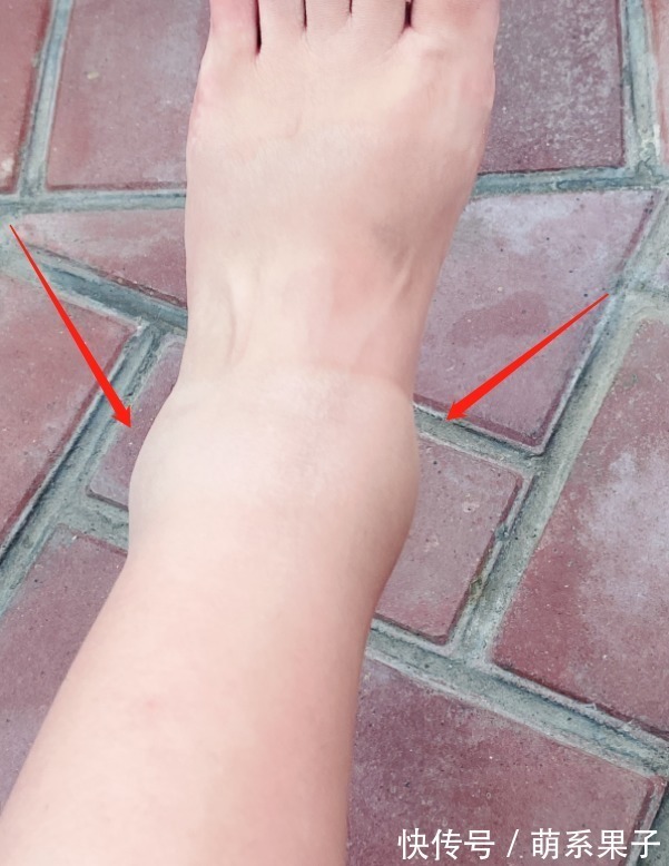 早产|红果果控制不住自己走了两万步,提前两周产子,劝孕妇听医生话