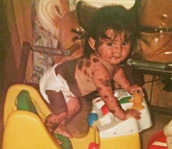 胎记|17岁姑娘满身胎记,从小被人嘲笑,妈妈这是上帝留下的吻痕