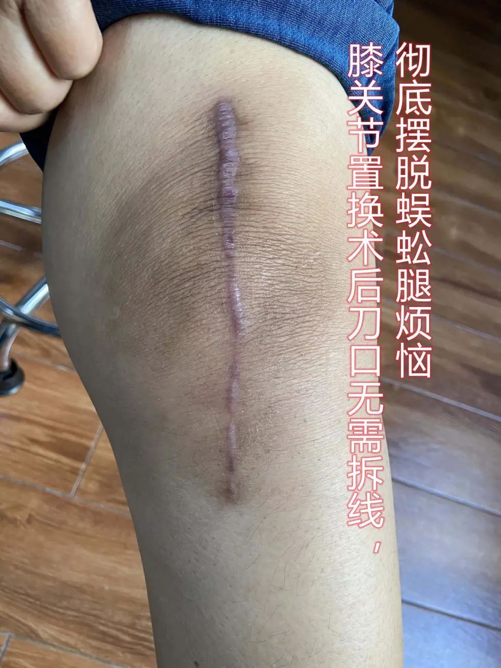 膝关节|潍坊市中医院专家为您解答膝关节置换是“忍无可忍”？还是“长痛不如短痛”？