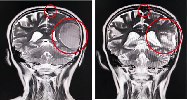 李姐|体检发现颅内小型良性肿瘤，是选择手术还是随访观察？