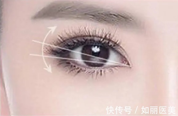 埋线双眼皮 割双眼皮需要多少钱?原来手术方式不一样价格也不同!快来看看你割双眼皮需要多少钱?