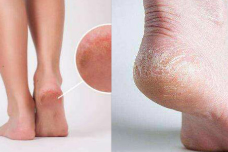 月牙|“肾”好不好看脚,如果脚上没有这3个表现,说明你的肾很健康