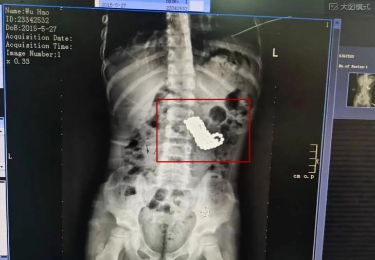 放进|5岁小孩看电视入迷,拿磁力珠放进嘴里,连吞123颗,震惊医生