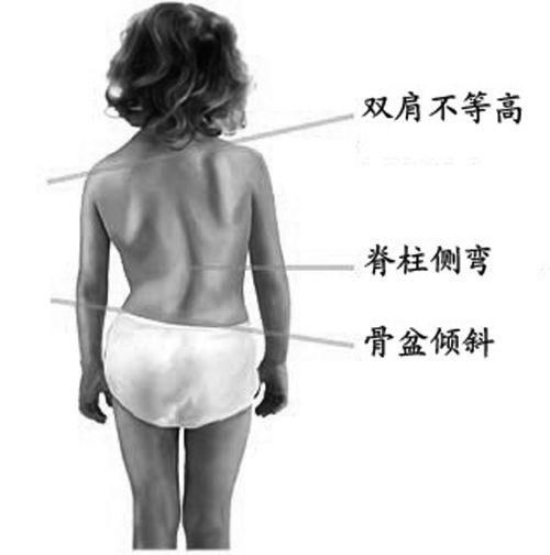 受压|8岁男孩脊椎侧弯,只因家人常做这个动作,这个错误,90%的父母都在犯