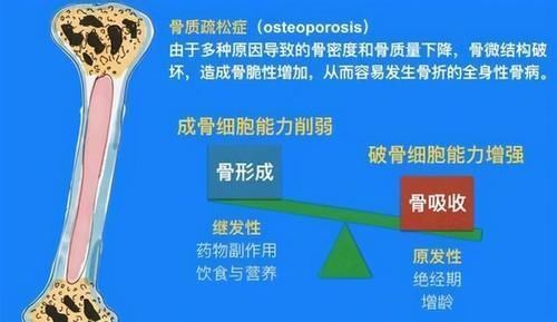 怒斥|45岁女子每天坚持喝酸奶，骨质疏松入院，医生怒斥：这不是胡闹吗