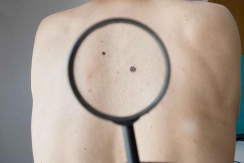 症状|皮肤有4个表现，皮肤癌或已找上门，发现一个，也别轻视
