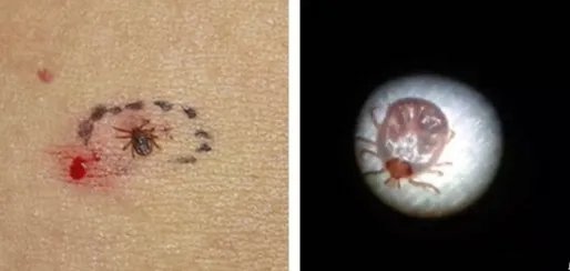 刘中波|2岁小孩被蜱虫吸血多天,虫子涨大几十倍,取下来还活着