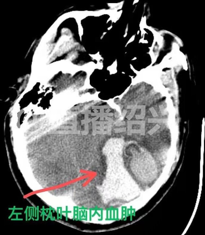 一男子昏迷不醒，医生说他脑子里长了个“灯泡”