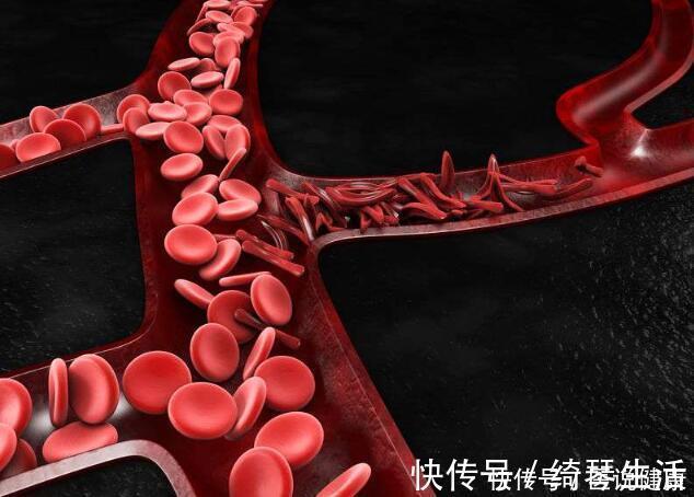 海带|这7种食物是血栓的“克星”,适当的多吃一些,血管干净不堵塞
